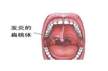 扁桃体炎